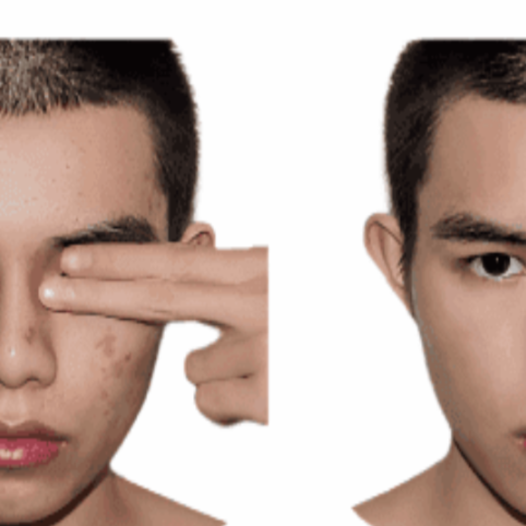 Organic Anti-Acne Three-Step System - Moderate/Severe Acne Prone Skin - For MEN